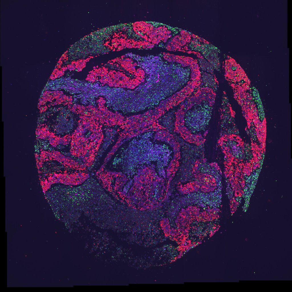 Fluorescence microscopy image of a round core of human breast tumor tissue, with cell populations labeled in pink, purple and green.