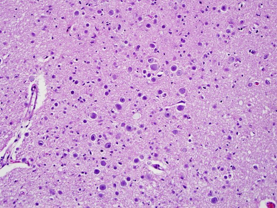 Microscope image of brain tissue densely scattered with small round polyglucosan bodies stained pale purple.
