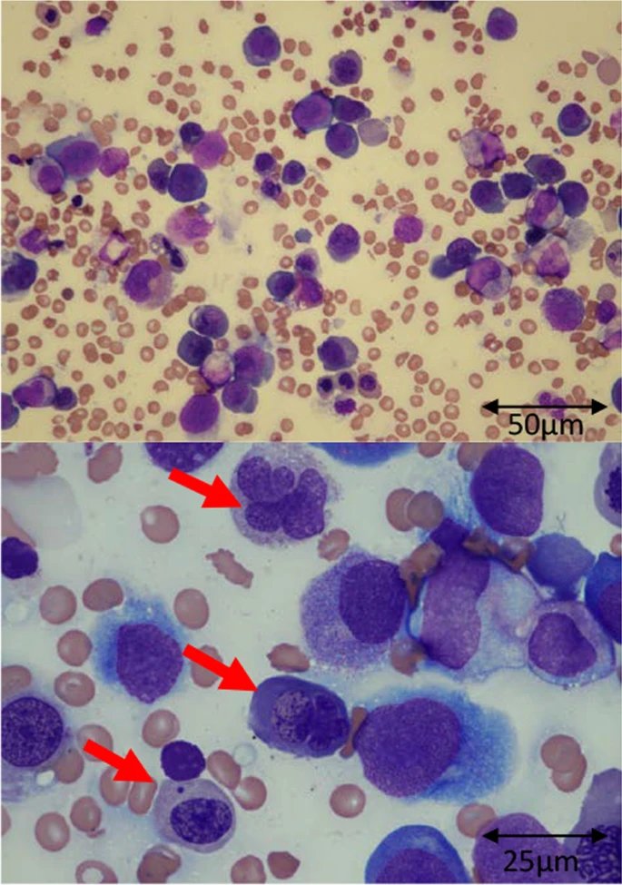 Two-panel light micrograph of a stained bone marrow smear, purple cells on a pale background, with red arrows marking individual cells in the lower panel and scale bars of 50 and 15 micrometers.