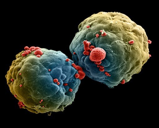 Scanning electron micrograph of two rounded clusters of breast cancer cells, colored blue and yellow, with red cells on their surfaces.