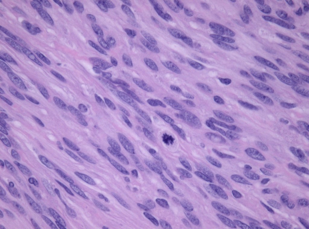 A microscope view of meningioma tissue stained pink and purple, with a dark dividing cell near the center.