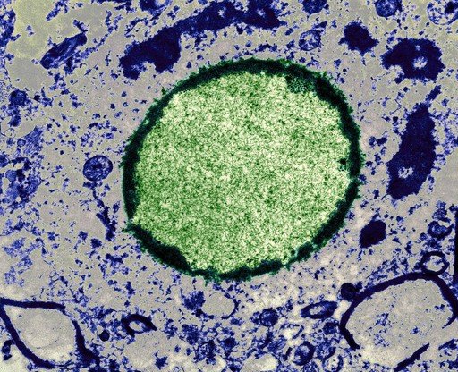 Colorized electron micrograph of a large, round, green mass of measles virus material packed inside an infected cell.