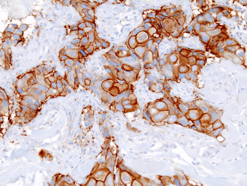 A microscope view of breast tumor tissue in which cell membranes are stained dark brown, marking the HER2 protein, against a pale blue background.