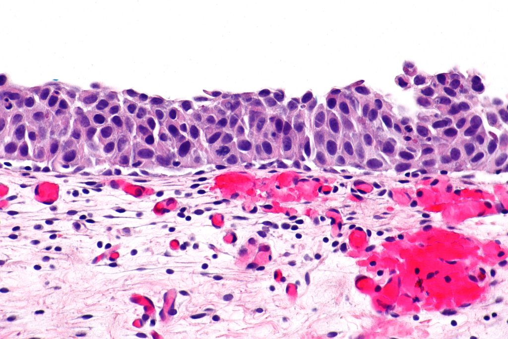 Micrograph of bladder lining showing a flat layer of abnormal cells with enlarged dark nuclei sitting above pink tissue.