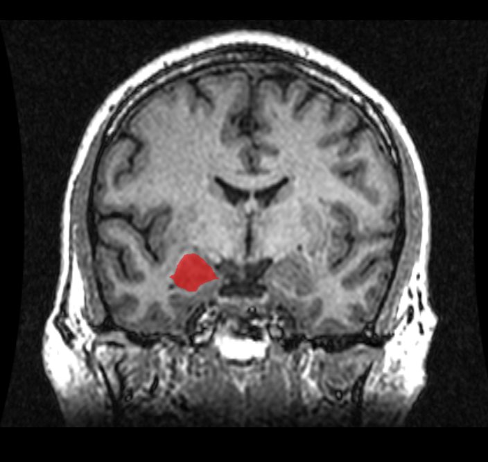 A grayscale coronal MRI slice of a human head with a small red region marking the amygdala beneath the cortex.