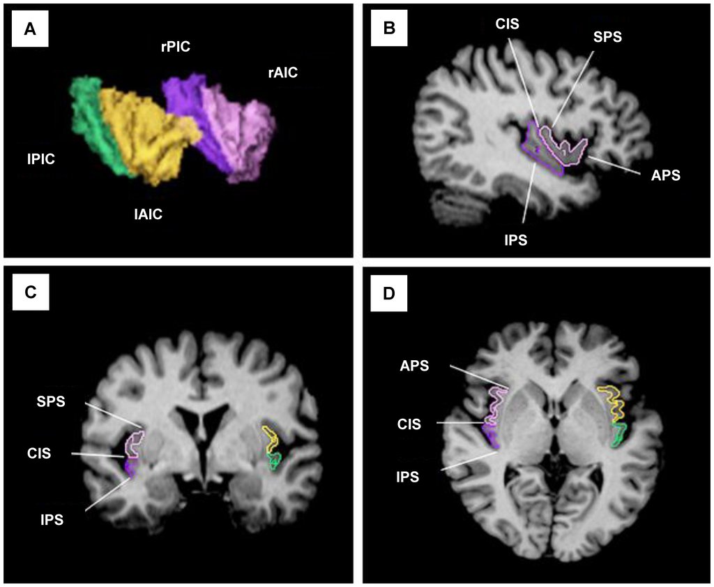 Four panels showing front and rear parts of the insular cortex outlined in color on magnetic resonance sections of a human brain, with a three dimensional reconstruction at upper left.