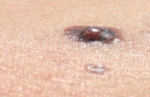 Close-up of skin with a dark raised nodular melanoma lesion and a smaller pale lesion below it